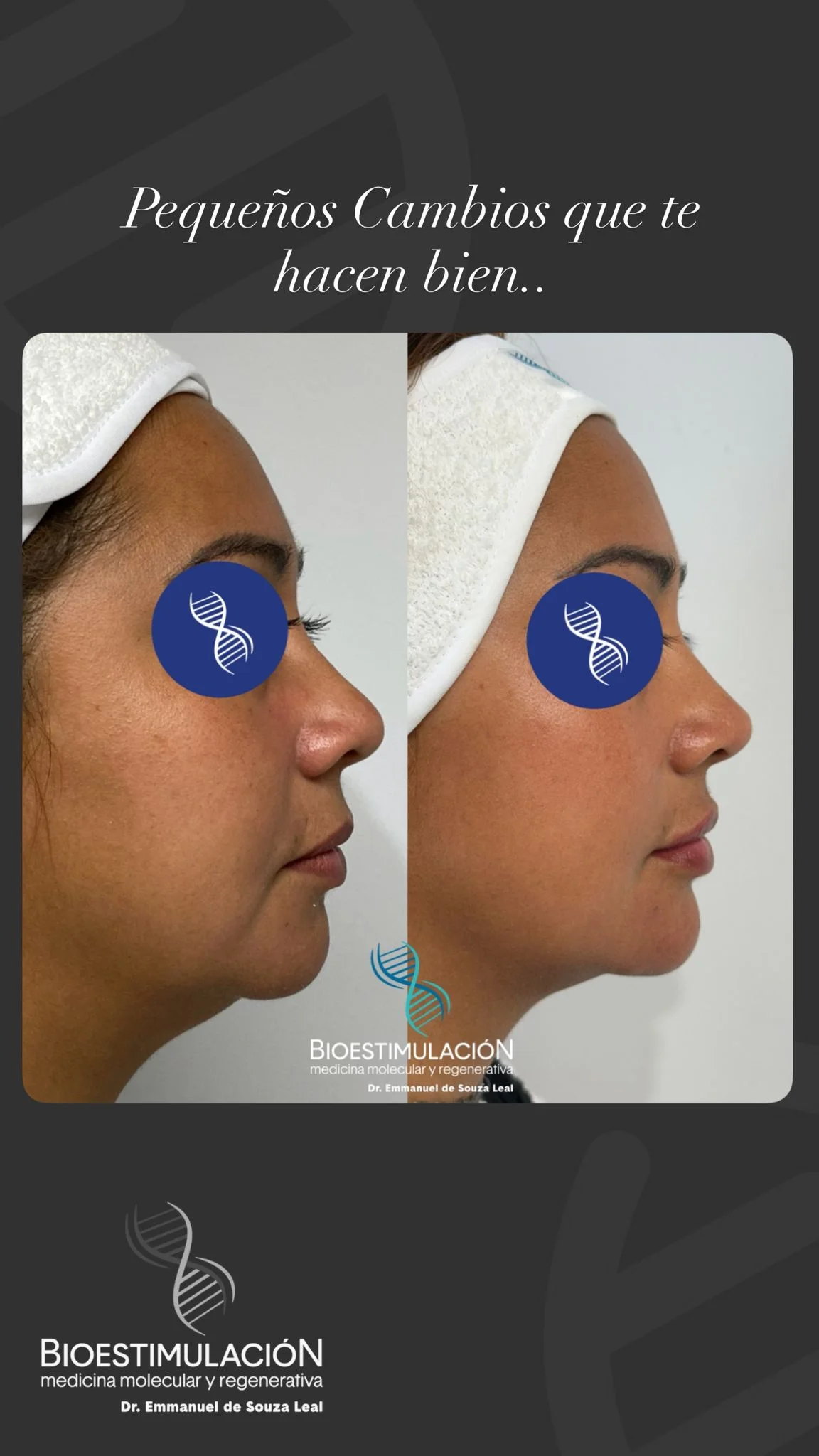 Resultado de tratamiento estético en Montevideo – Bioestimulación